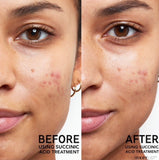 Succinic Acid Acne Treatment